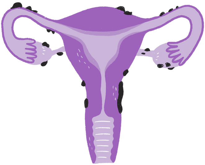 Эндометриоз. Как разобраться в причинах и симптомах и позаботиться о себе в повседневной жизни Эндометриоз. Как разобраться в причинах и симптомах и позаботиться о себе в повседневной жизни