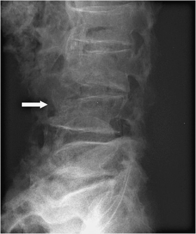 Остеопороз. Руководство для практических врачей Остеопороз. Руководство для практических врачей