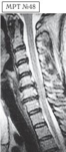 Остеохондроз для профессионального пациента