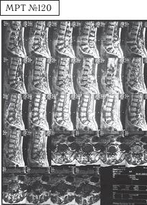 Остеохондроз для профессионального пациента Остеохондроз для профессионального пациента
