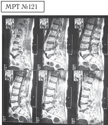 Остеохондроз для профессионального пациента Остеохондроз для профессионального пациента