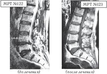 Остеохондроз для профессионального пациента Остеохондроз для профессионального пациента