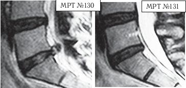 Остеохондроз для профессионального пациента Остеохондроз для профессионального пациента