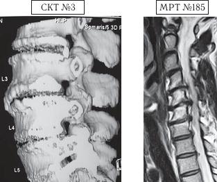 Остеохондроз для профессионального пациента Остеохондроз для профессионального пациента