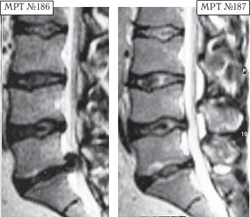 Остеохондроз для профессионального пациента Остеохондроз для профессионального пациента