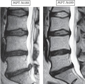 Остеохондроз для профессионального пациента Остеохондроз для профессионального пациента