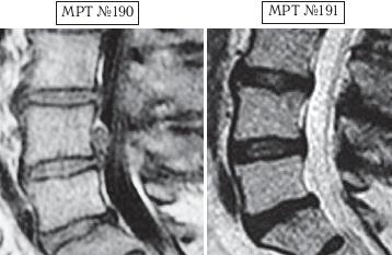 Остеохондроз для профессионального пациента Остеохондроз для профессионального пациента