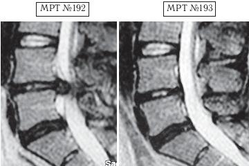 Остеохондроз для профессионального пациента Остеохондроз для профессионального пациента