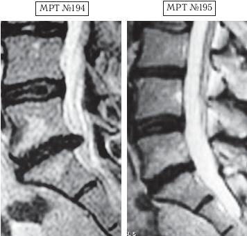 Остеохондроз для профессионального пациента Остеохондроз для профессионального пациента