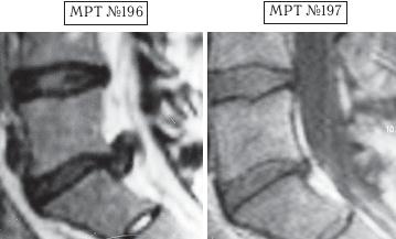 Остеохондроз для профессионального пациента Остеохондроз для профессионального пациента
