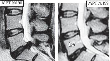 Остеохондроз для профессионального пациента Остеохондроз для профессионального пациента
