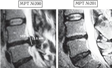 Остеохондроз для профессионального пациента Остеохондроз для профессионального пациента
