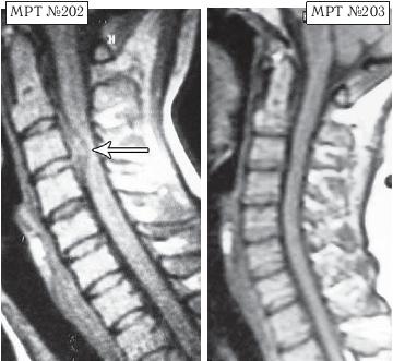 Остеохондроз для профессионального пациента Остеохондроз для профессионального пациента