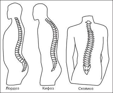 Остеохондроз. Как победить боль