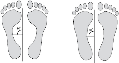 Плоскостопие. Самые эффективные методы лечения