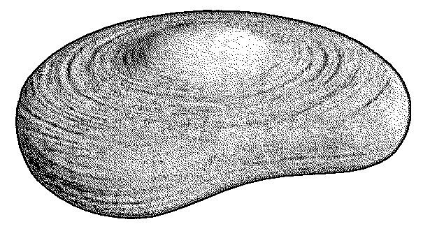 Остеохондроз Остеохондроз
