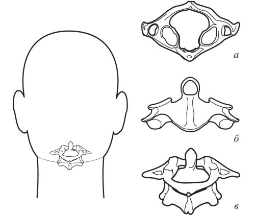 Остеохондроз Остеохондроз