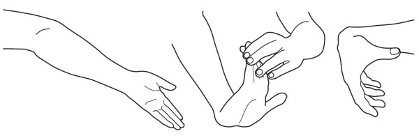 Остеохондроз Остеохондроз