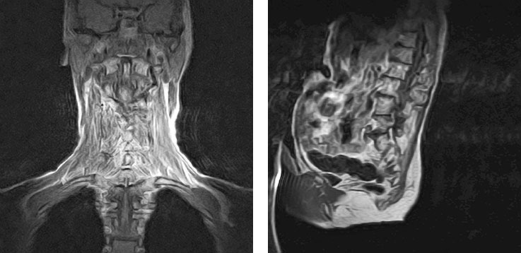 Йога при остеопорозе