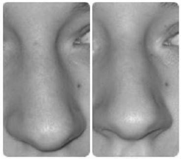 Биогимнастика для лица: система фейсмионика