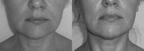 Биогимнастика для лица: система фейсмионика