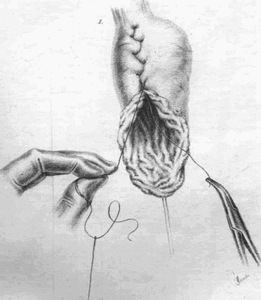 Этюды желудочной хирургии