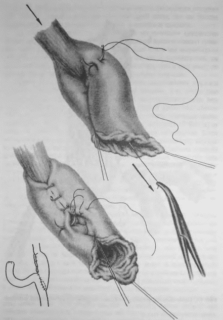 Этюды желудочной хирургии