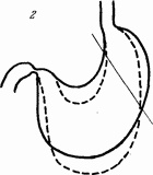 Этюды желудочной хирургии