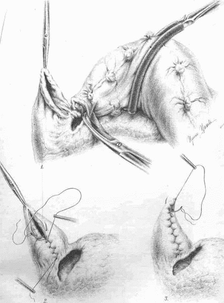 Этюды желудочной хирургии