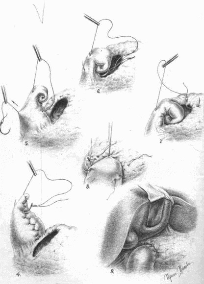 Этюды желудочной хирургии