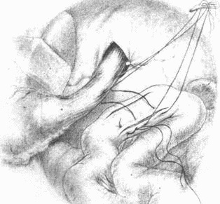 Этюды желудочной хирургии