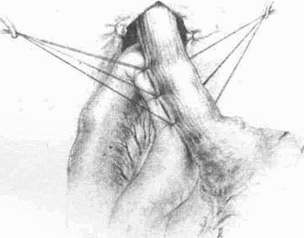 Этюды желудочной хирургии